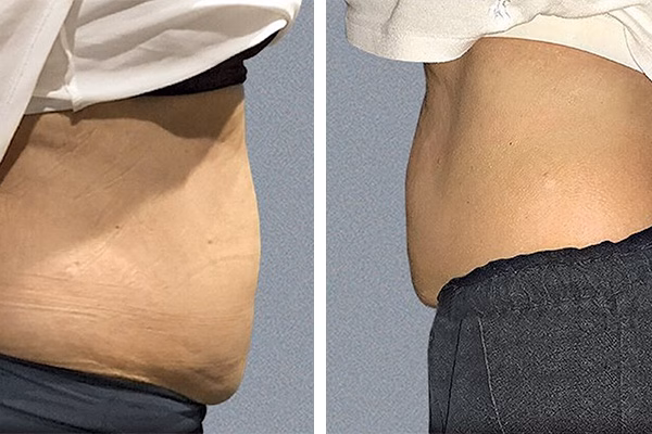 Before and after: Sculpted Contours with Cryo T-Shock