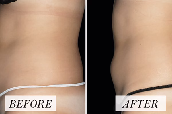 Before and after: Toned Muscles with EMS Sculpt