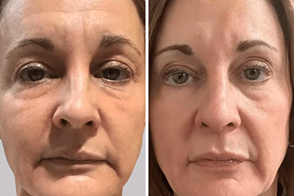 Before and after: Radiant Skin with Theralight 360